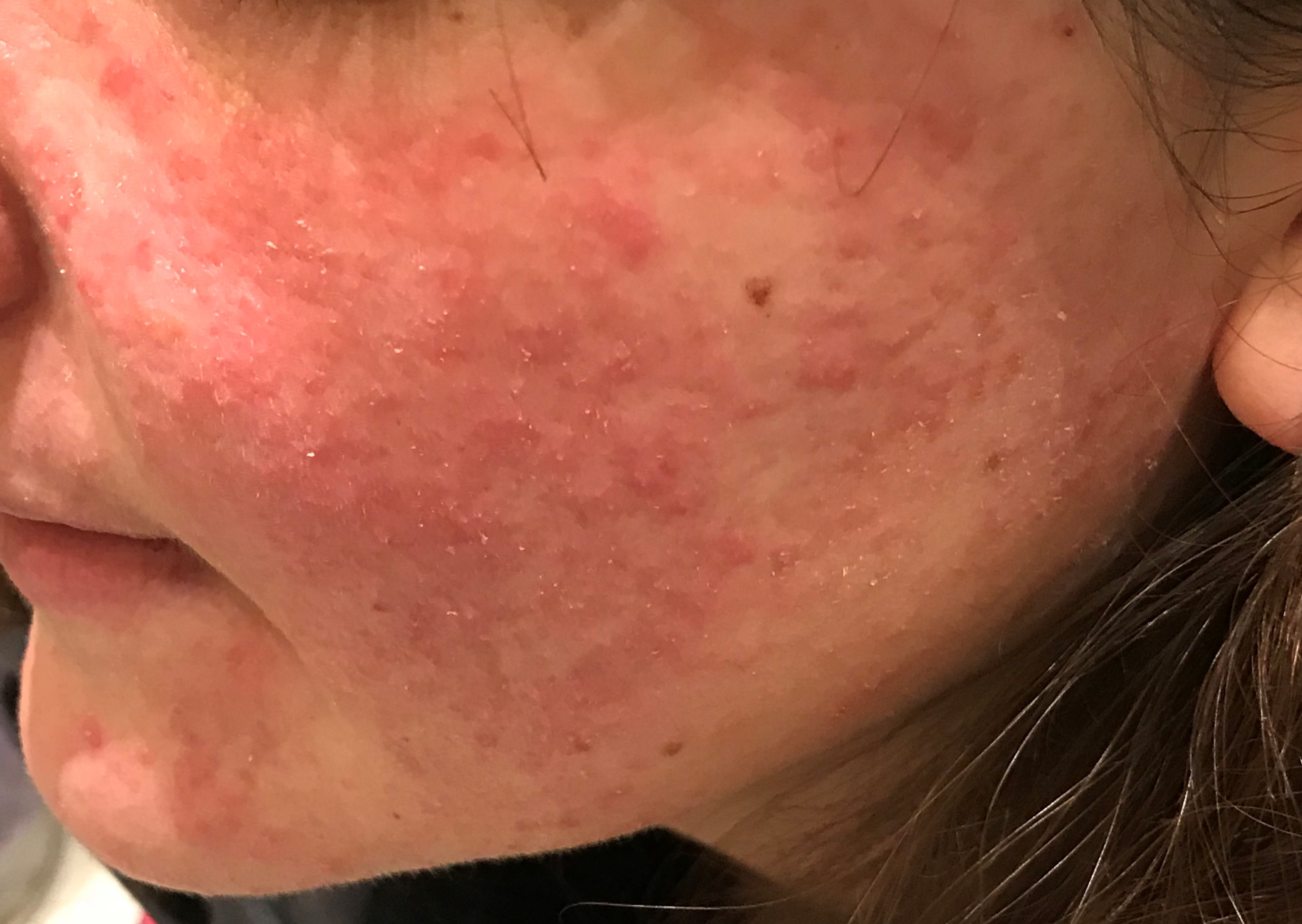 rosacea