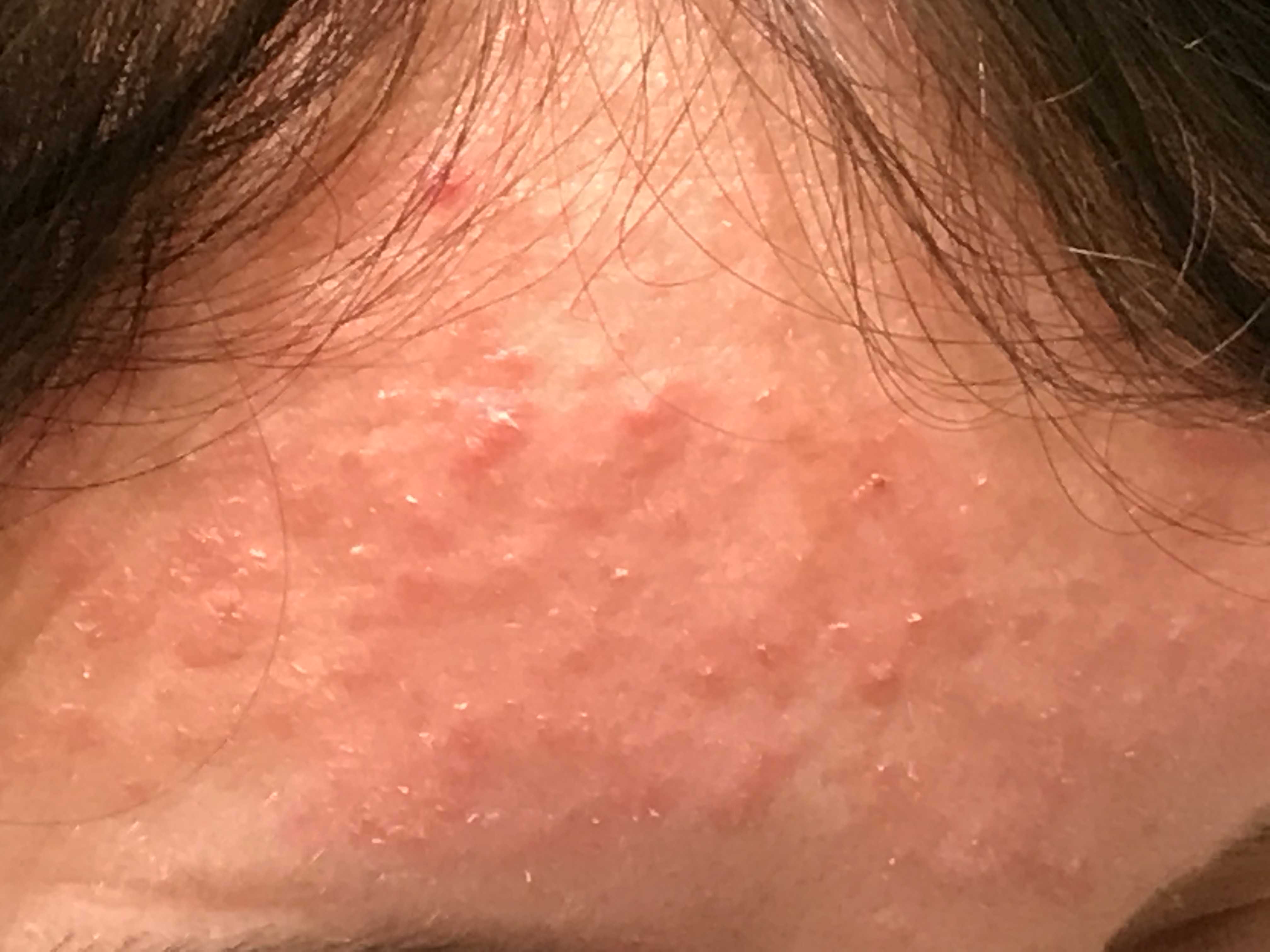 rosacea