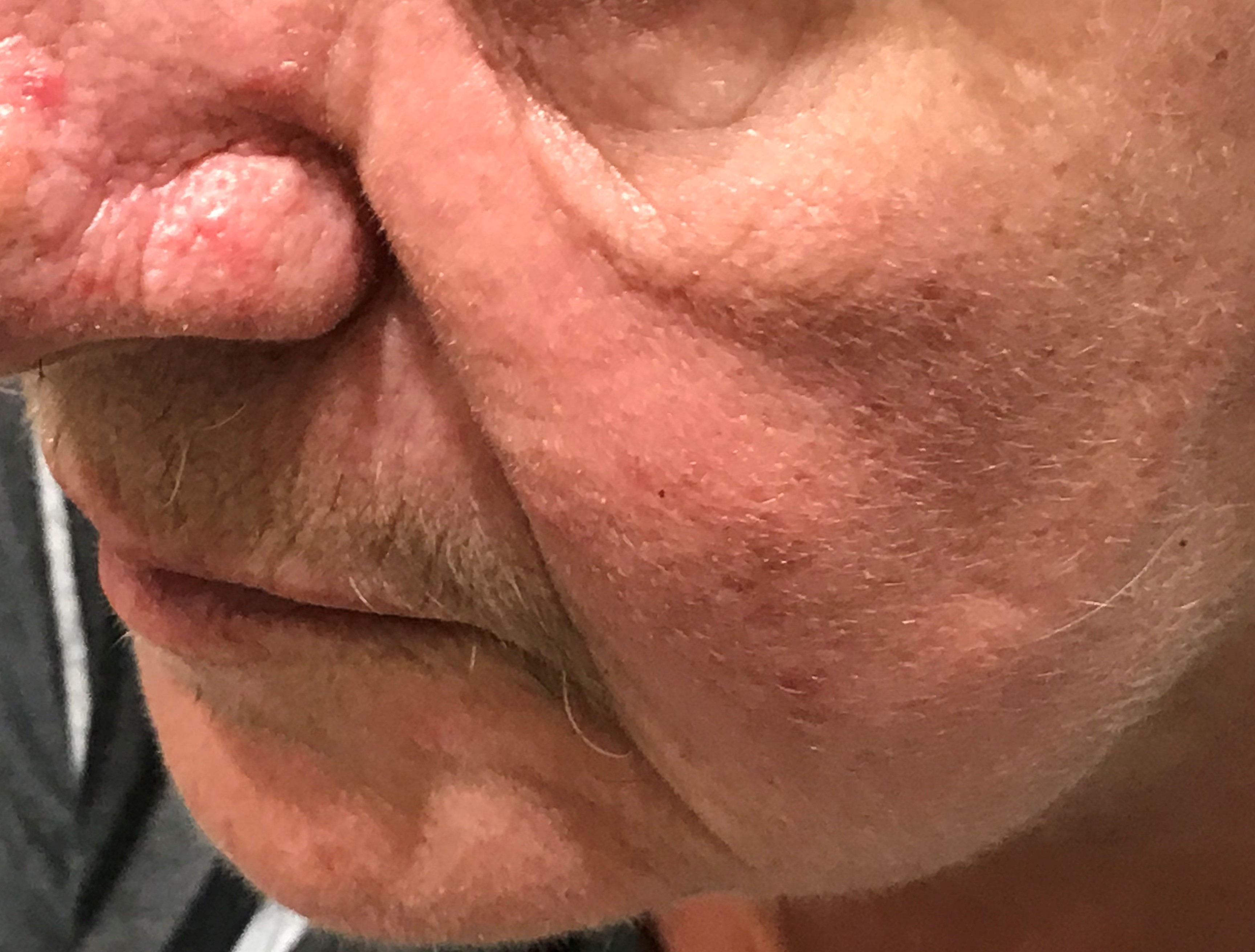 rosacea