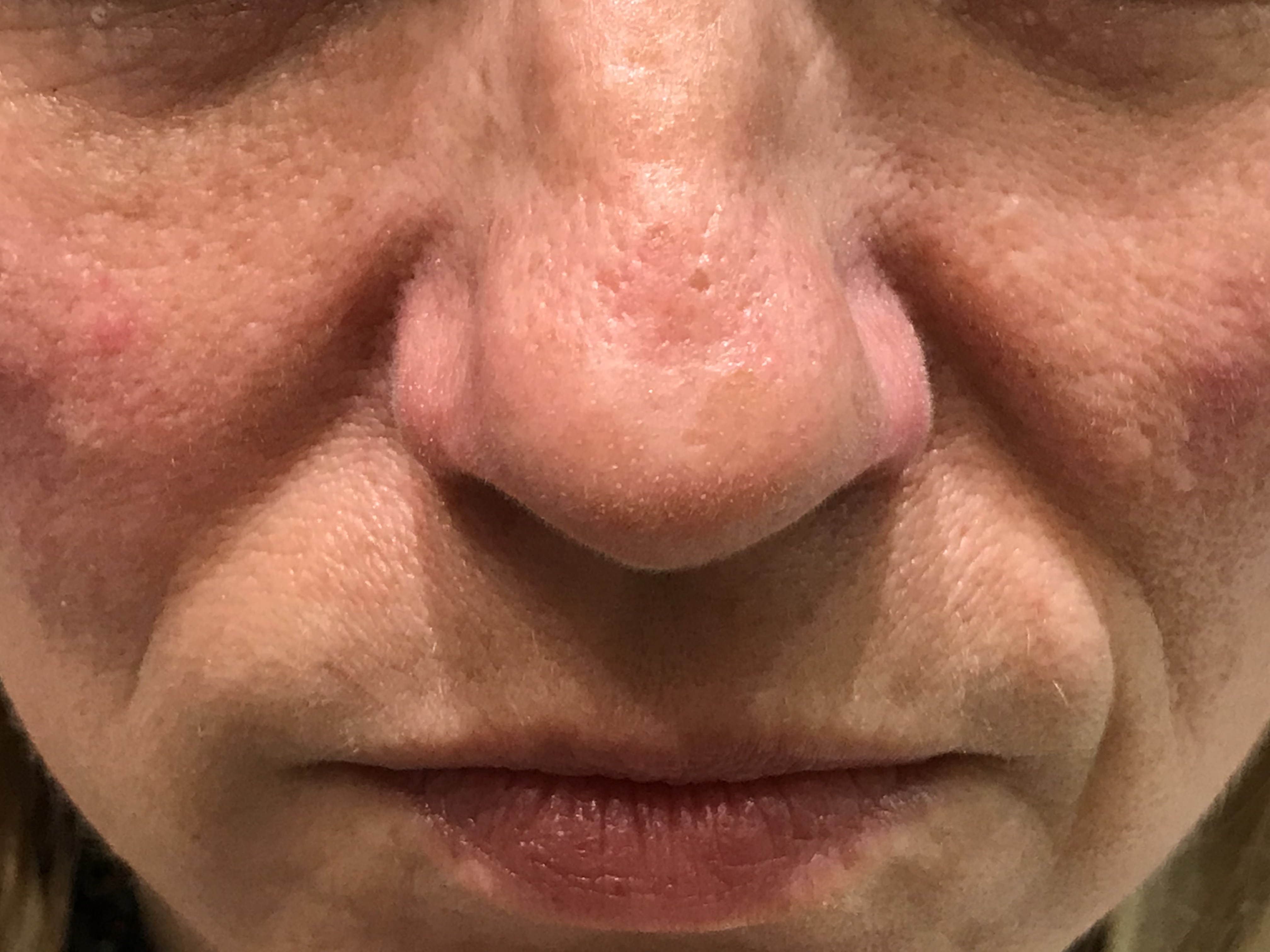 rosacea