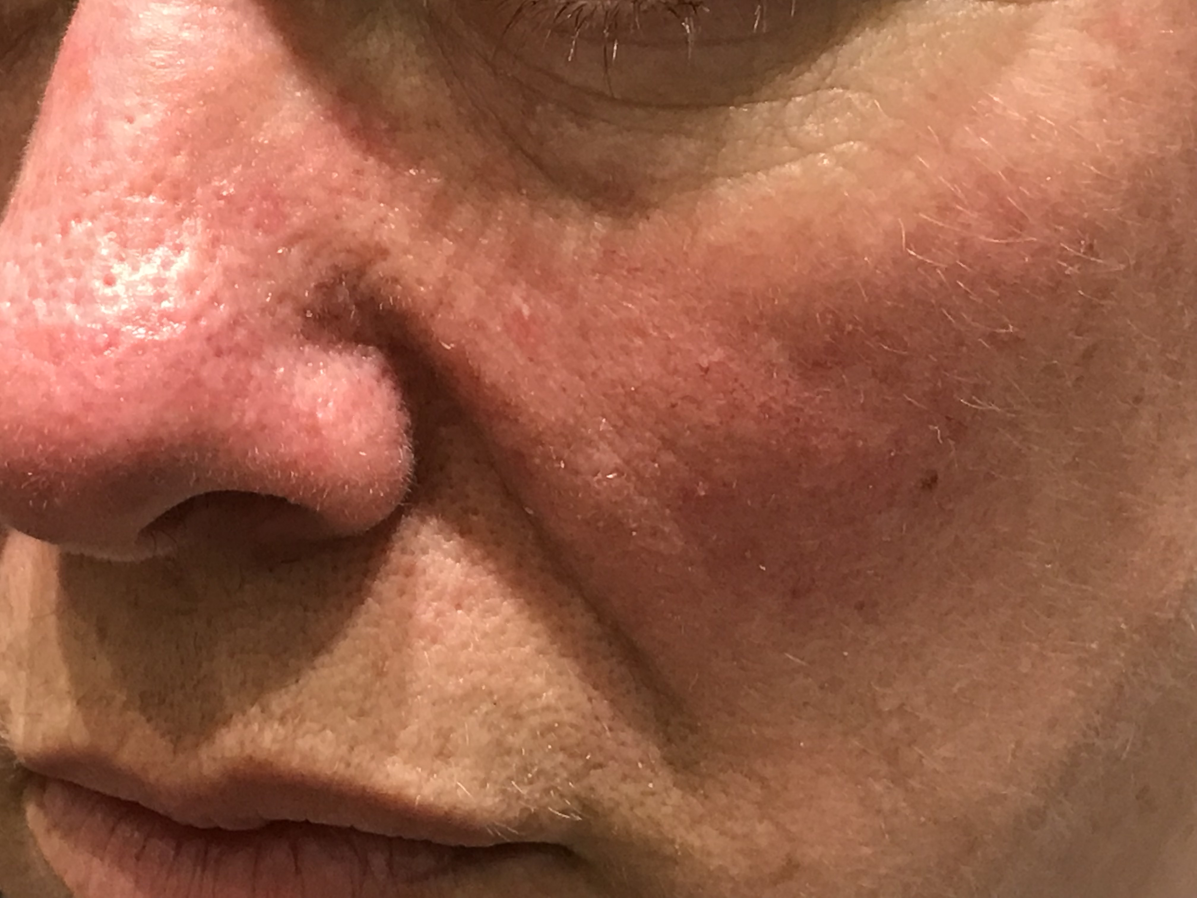 rosacea