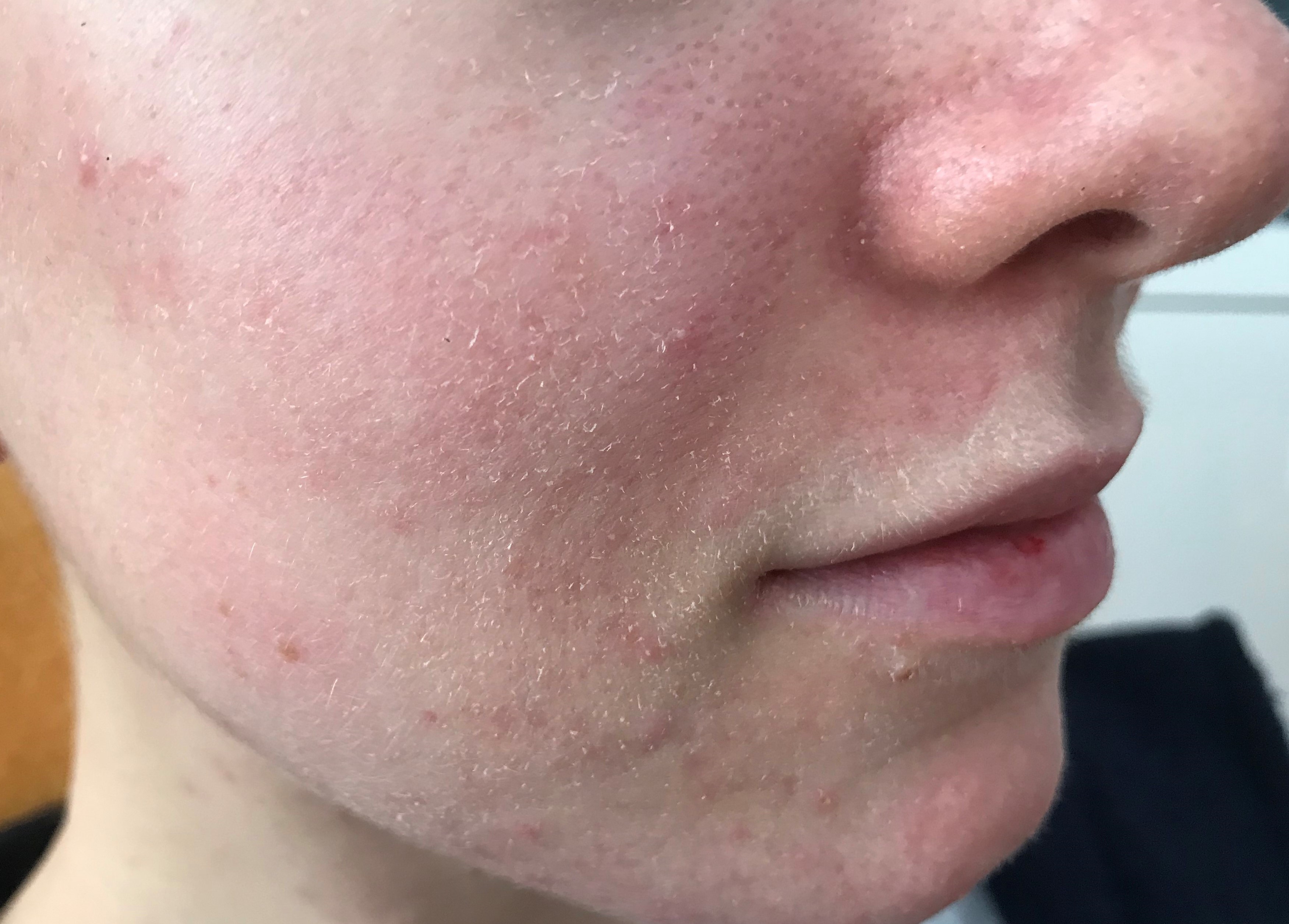 rosacea