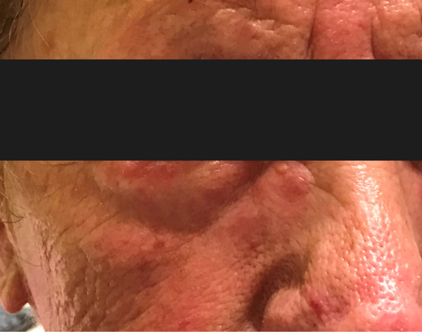 rosacea