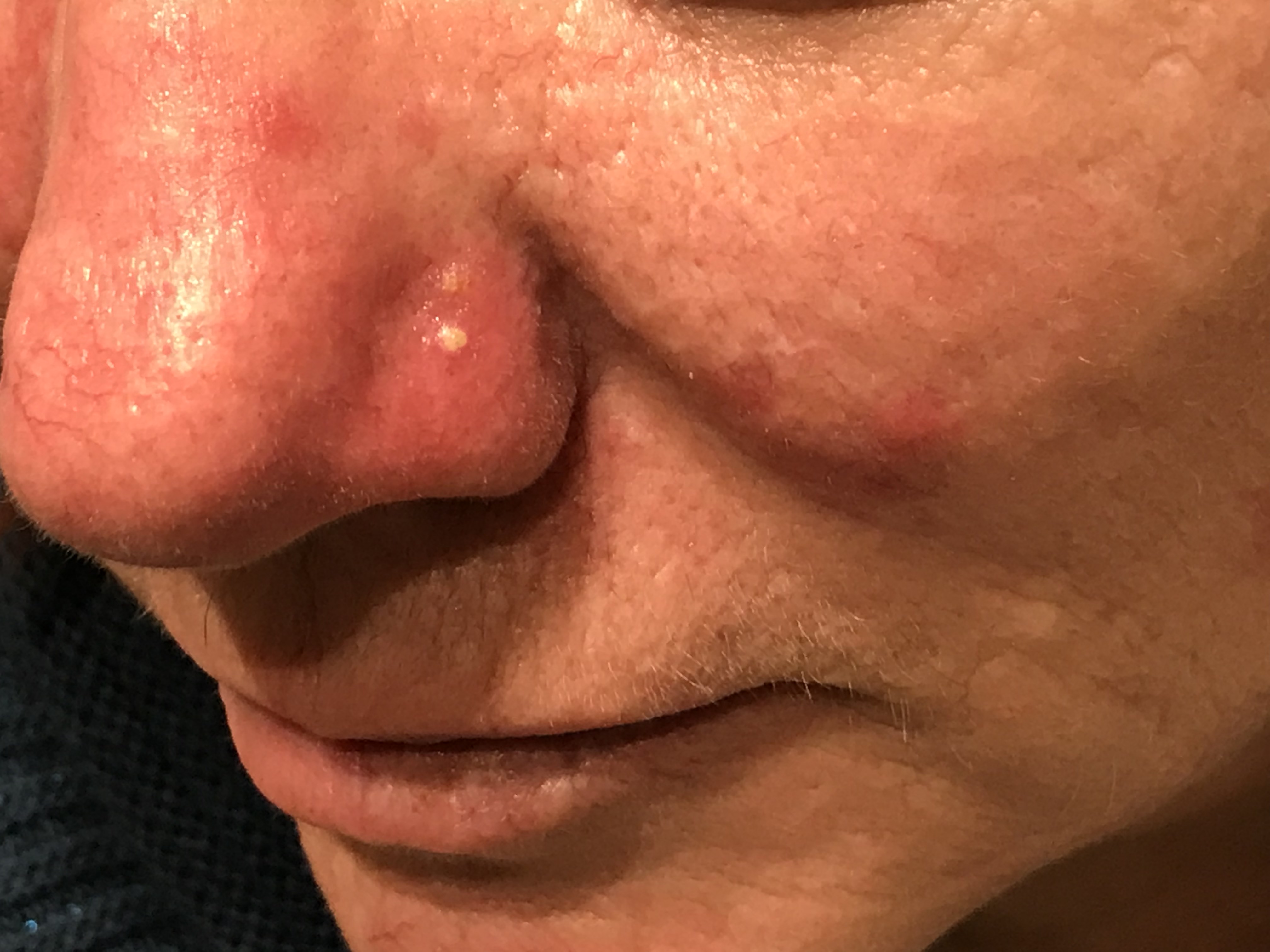 rosacea