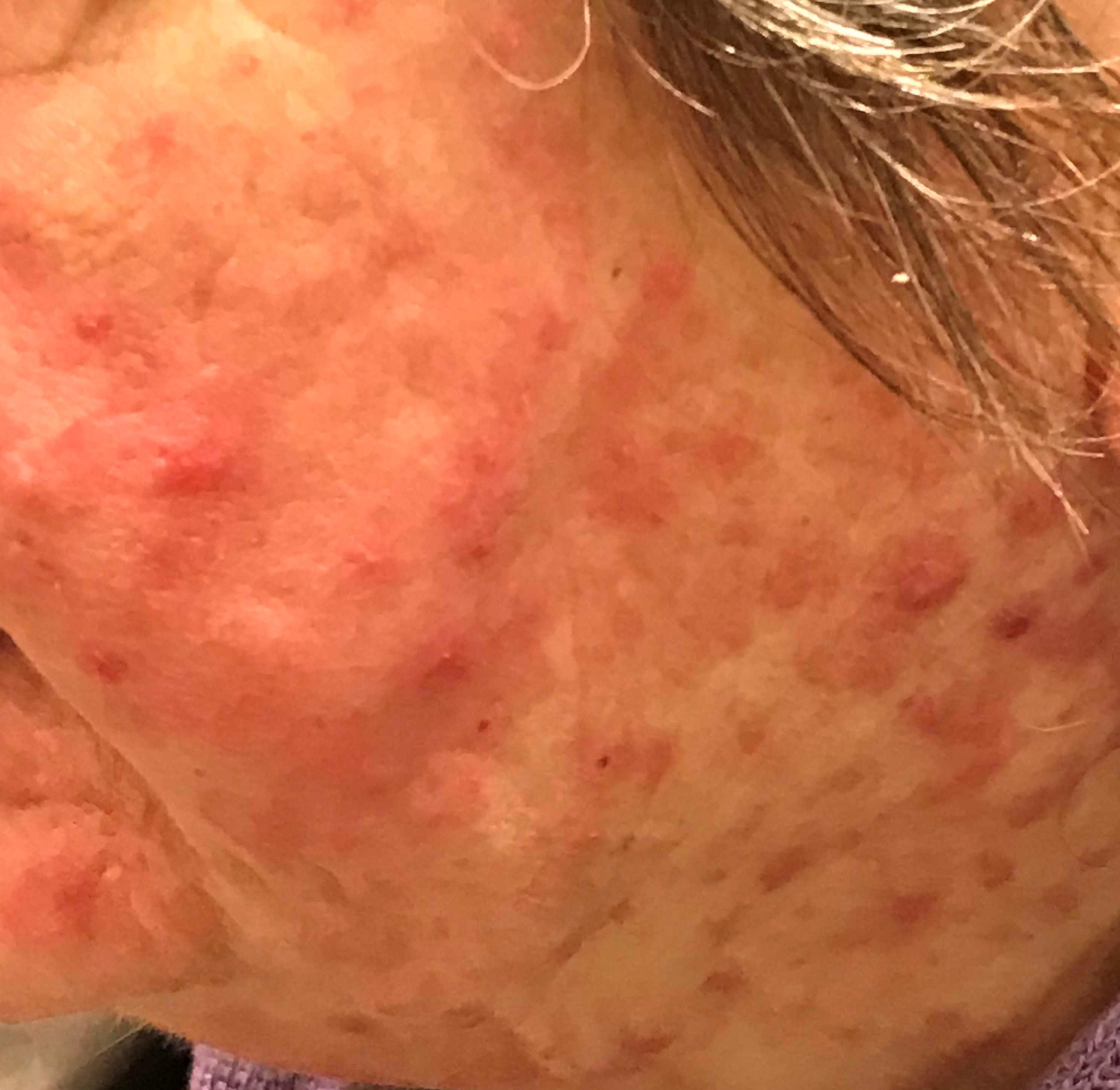 rosacea