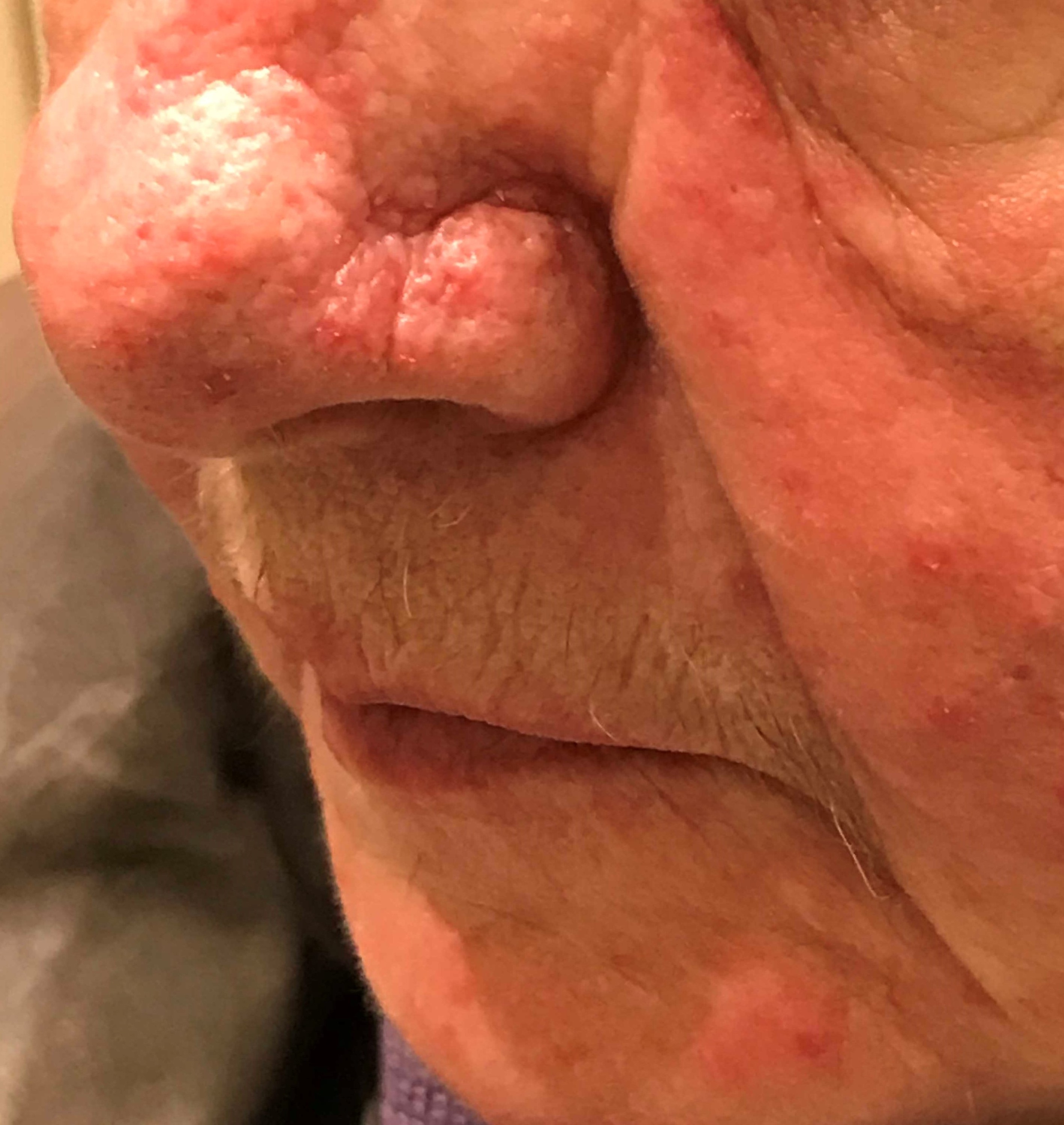 rosacea