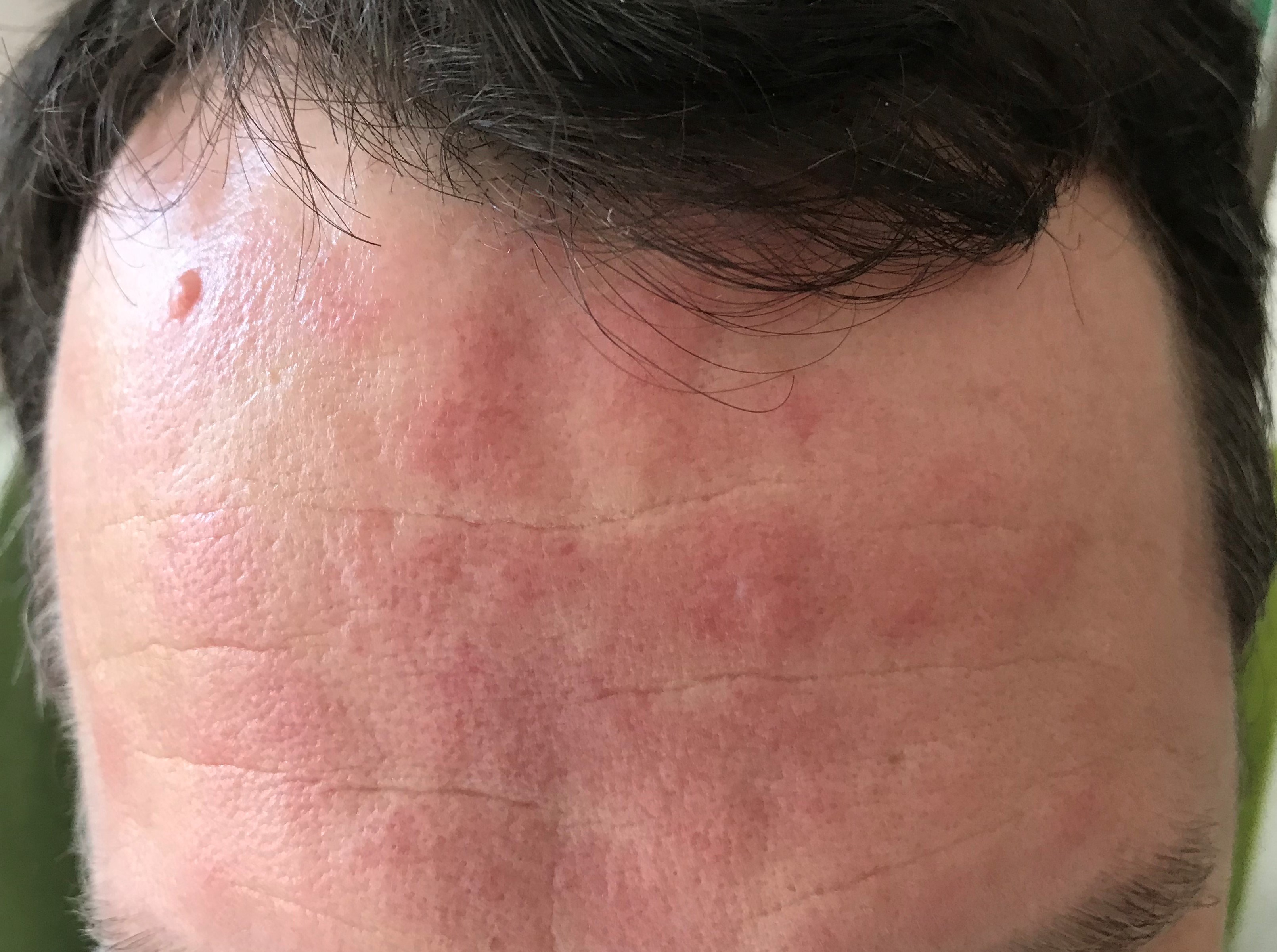 rosacea