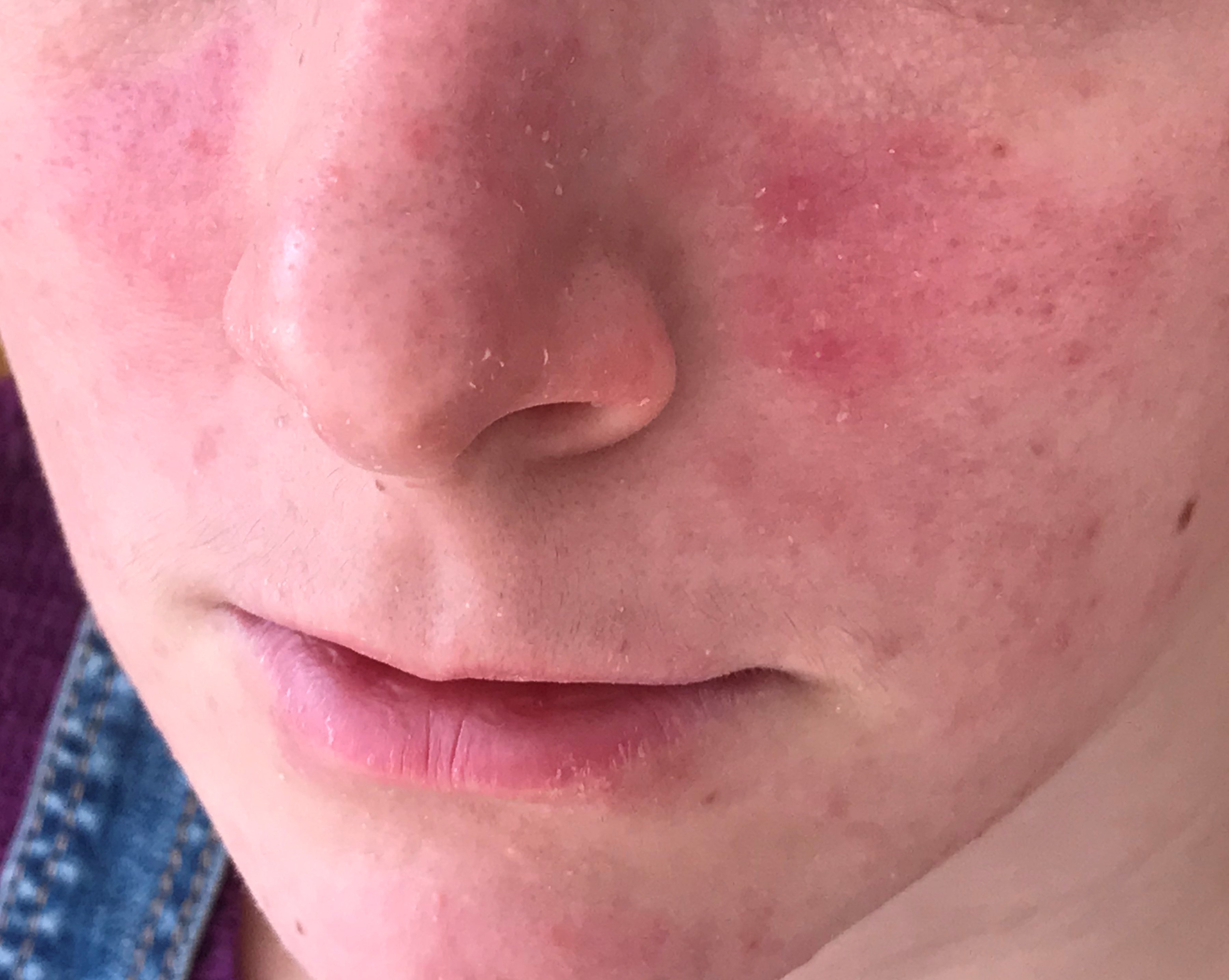 rosacea