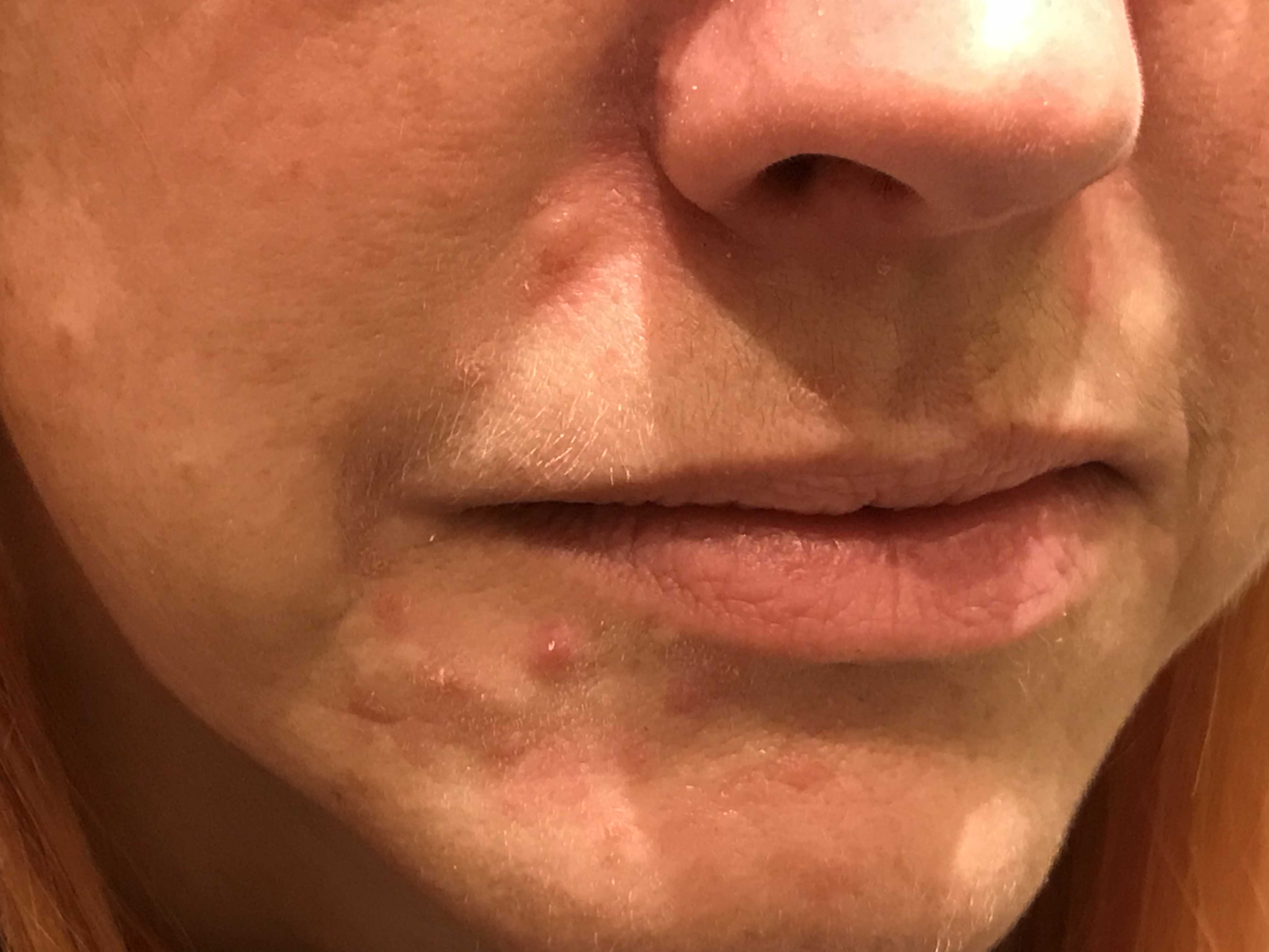 rosacea
