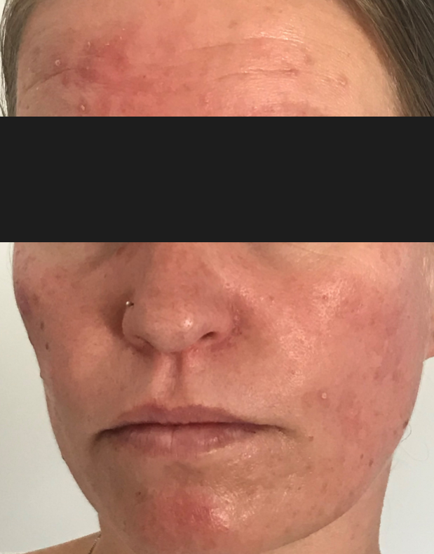 rosacea